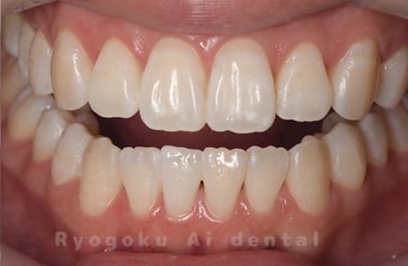 オフィスホワイトニング術後