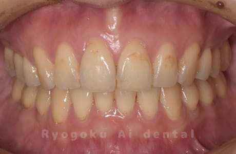 オフィスホワイトニング＋ホームホワイトニング術前