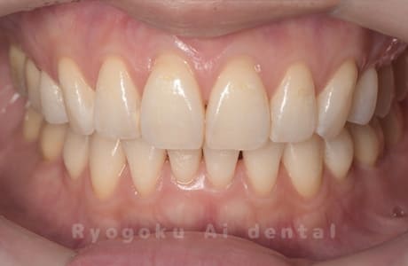 オフィスホワイトニング＋ホームホワイトニング術後