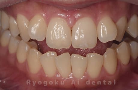 ホームホワイトニング（カスタム）術前