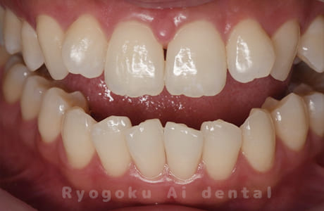 ホームホワイトニング（カスタム）術後