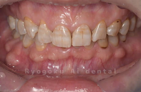 オフィスホワイトニング（１回）術後