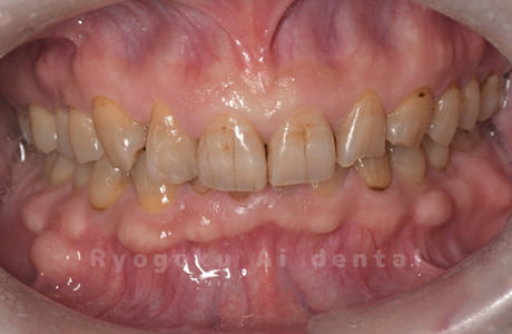 オフィスホワイトニング（１回）術前