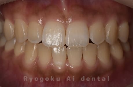 ホームホワイトニング（カスタムトレー法）術前