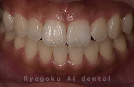 ホームホワイトニング（カスタムトレー法）術後