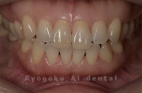 ホームホワイトニング（カスタムトレー法）術前