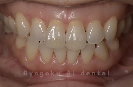 ホームホワイトニング（カスタムトレー法）術後