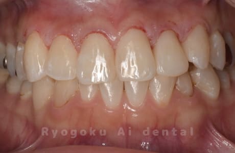 ホームホワイトニング（既成トレー法）、オフィスホワイトニング術後