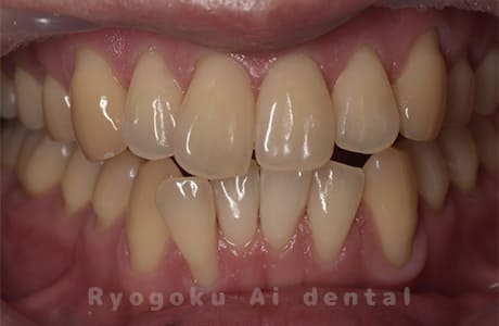 ホームホワイトニング（カスタムトレー法）術前