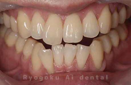 ホームホワイトニング（カスタムトレー法）術後