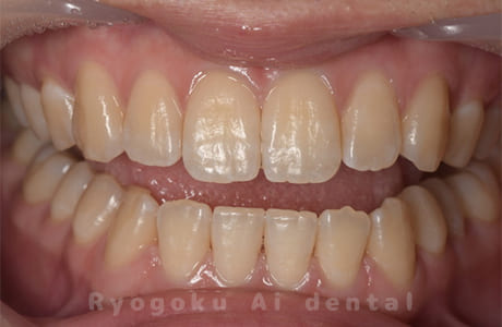 ホームホワイトニング（既成トレー法）術前