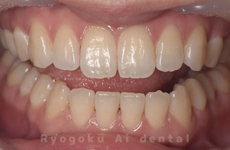 ホームホワイトニング（既成トレー法）術後