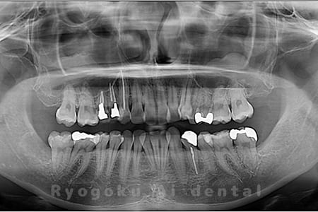 下顎の水平埋伏智歯を抜歯