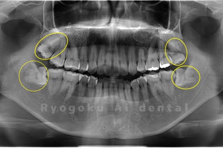 上下4本の親知らずの