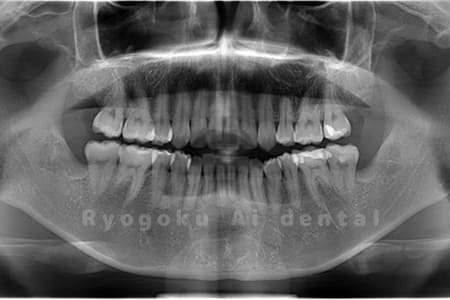 上下4本の親知らずの抜歯