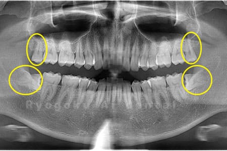 下顎の水平埋伏智歯