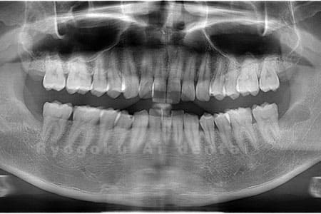 下顎の水平埋伏智歯を抜歯