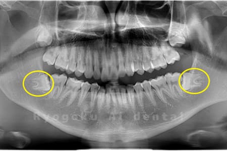 下顎の親知らず2本