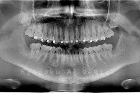 下顎の親知らず2本抜歯