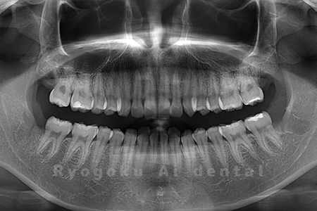 上下の親知らず4本抜歯
