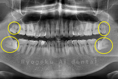 上下の親知らず4本