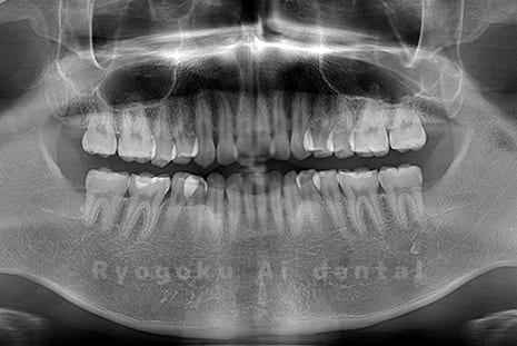 上下の親知らず4本抜歯