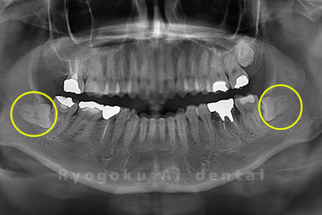 下顎の親知らず2本