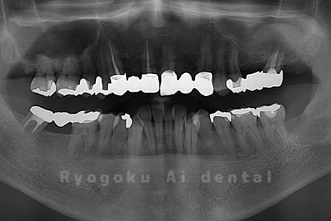 左下顎の水平埋伏智歯