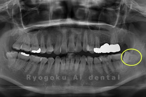 左下顎の親知らず