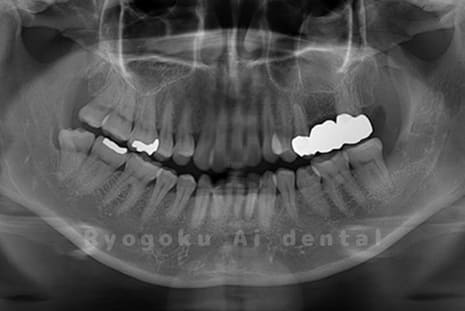 下顎左の親知らずを抜歯