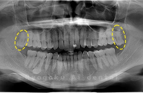 上顎左右の親知らず