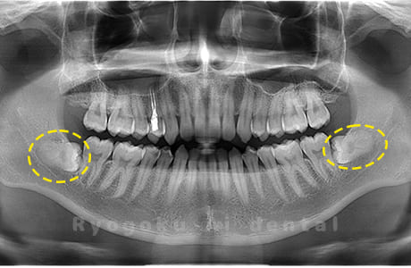 下顎左右の親知らず
