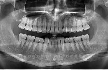 上顎左・下顎左の親知らずを抜歯