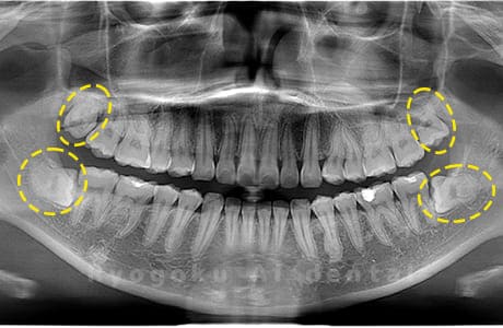 上顎左右・下顎左右の親知らず