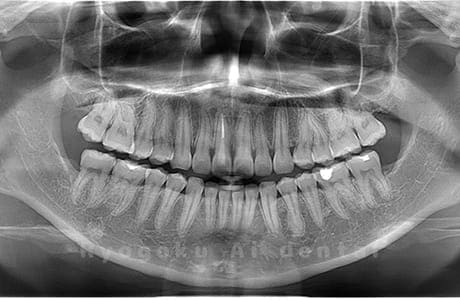 上顎左右・下顎左右の親知らずを抜歯