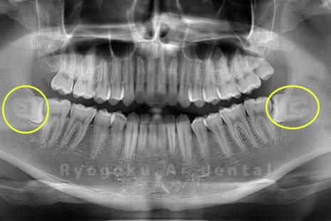 下顎左右の親知らず
