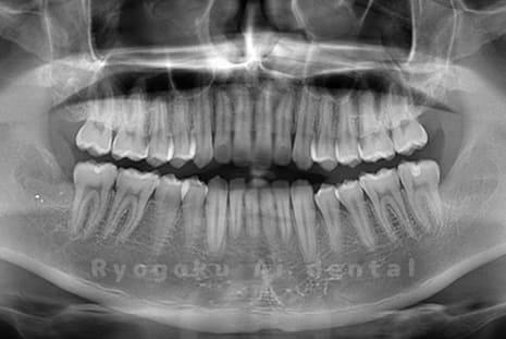 下顎左右の親知らずの抜歯