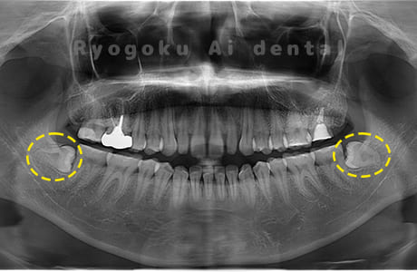 下顎左右の親知らず