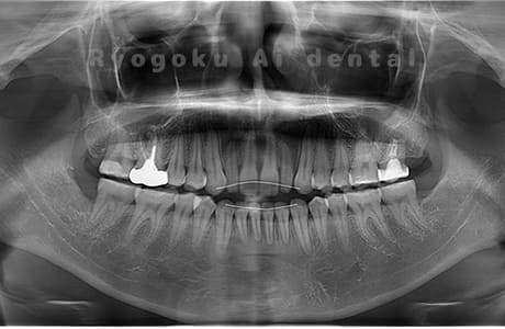 下顎左右の親知らずを抜歯