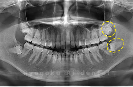 上下顎左の親知らず