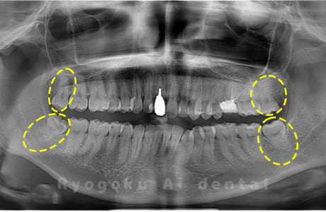 上下顎左右の親知らず