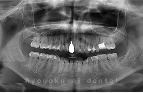 上下顎左右の親知らずを抜歯