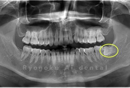 下顎左の親知らず