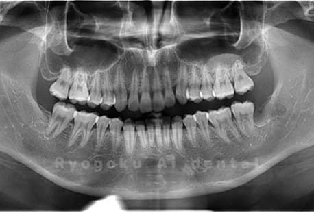 下顎左の親知らずの抜歯