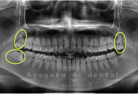 上顎下顎3本の親知らず