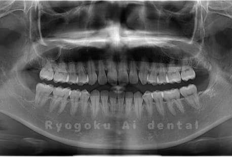 上顎下顎3本の親知らずを抜歯