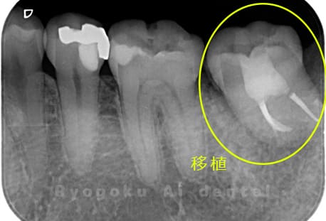 抜歯した親知らずを移植