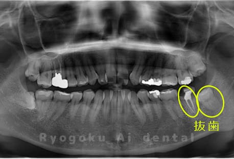 重度カリエスと親知らずを抜歯