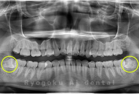 下顎左右2本の親知らず
