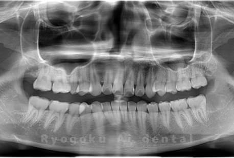 下顎左右2本の親知らずを抜歯